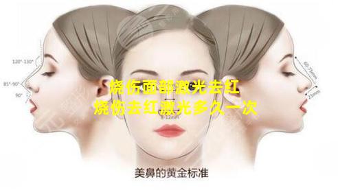 烧伤面部激光去红 烧伤去红激光多久一次